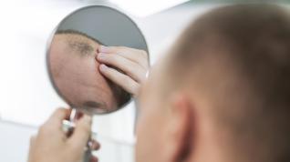 En el caso de los hombres la causa más común de la alopecia son las hormonas.