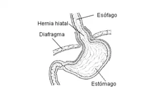 Esquema de hernia de hiato por deslizamiento.