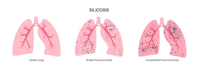 Proceso Silicosis.